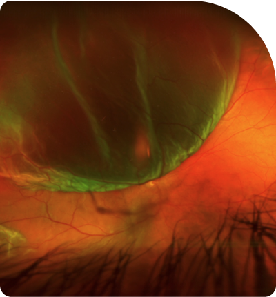 desprendimiento de retina