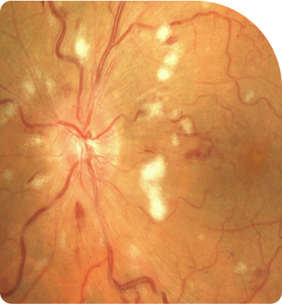 oclusiones venosas