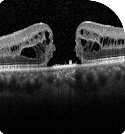 agujero macular