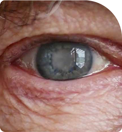 cataratas